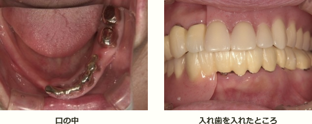 入れ歯を口の中に入れたところ